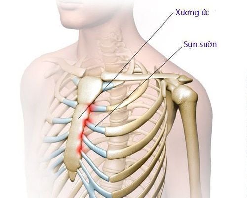 
Khi có biểu hiện viêm sụn sườn, người bệnh nên đi khám để có phương pháp chẩn đoán, điều trị và xử lý tốt nhất
