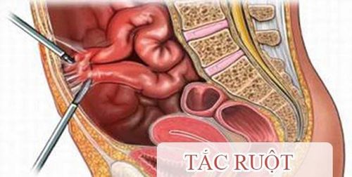 
Tắc ruột có thể gây cản trở sự lưu thông của thức ăn trong đường ruột
