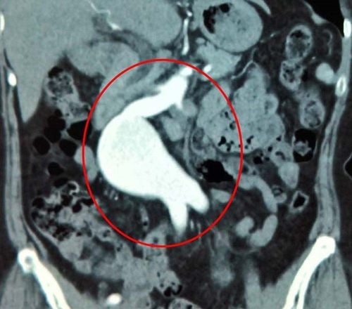 What's wrong with the 2nd surgery aneurysm? After how many years, surgery again?