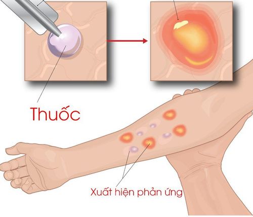 Skin test to detect allergies