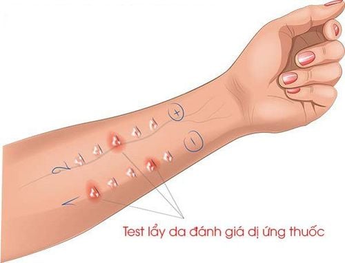 
Khi thực hiện test da cần lưu ý những vấn đề gì?
