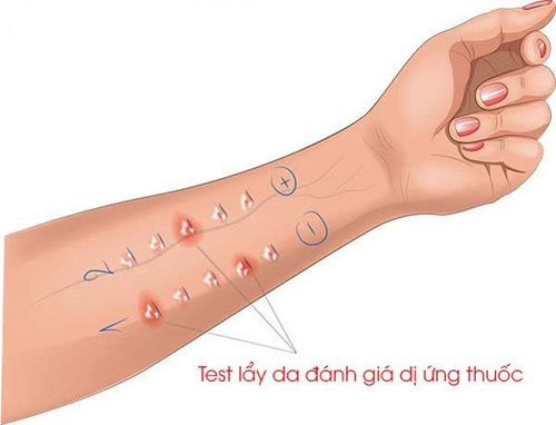 Test lẩy da đánh giá dị ứng thuốc