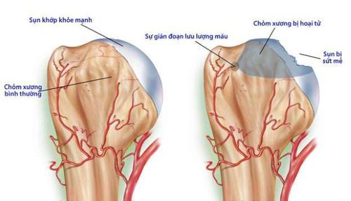 
Hoại tử chỏm là một trong những biến chứng của gãy xương hông.
