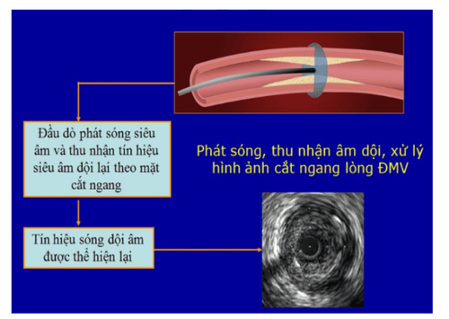 
Cơ chế kỹ thuật siêu âm trong lòng mạch
