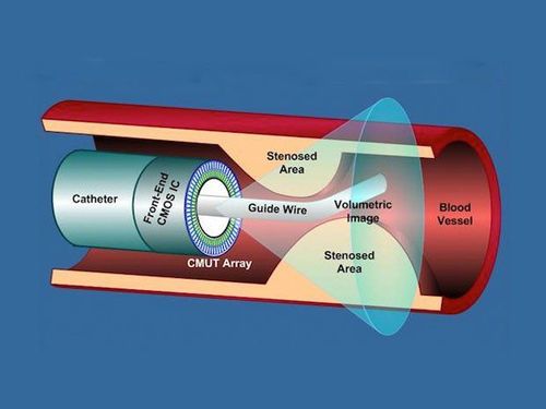 Ý nghĩa và ứng dụng của siêu âm trong lòng mạch vành (IVUS)