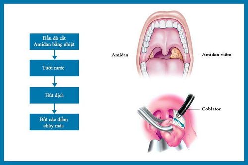 
Các công đoạn cắt Amidan bằng máy Coblator
