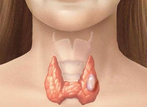 Nhân tuyến giáp thường là lành tính