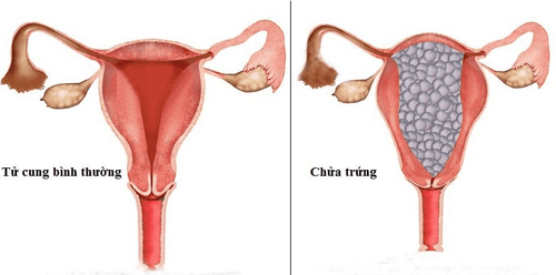 Hysterectomy in a patient with an ovum (ovulation)