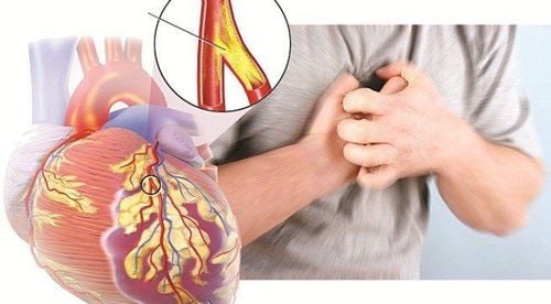 Expression and emergency treatment of cardiogenic shock