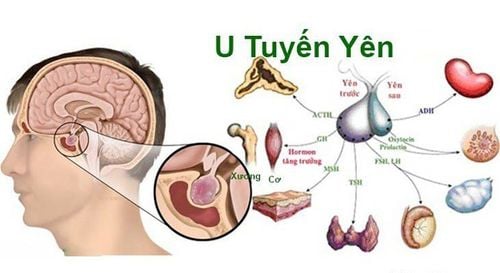 Các triệu chứng của u tuyến yên