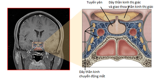 
Bệnh u tuyến yên ảnh hưởng nhiều đến khả năng nhìn của mắt
