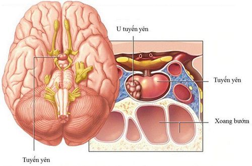 
U tuyến yên có những triệu chứng như thế nào?
