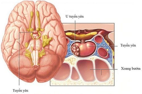 
U tuyến yên thường lành tính, hiếm khi là ác tính
