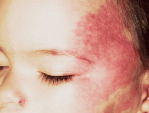 Hemangiomas in children are dangerous?