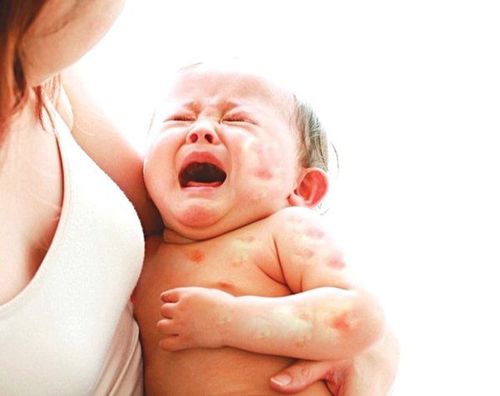 Hiện nay, tình trạng dị ứng thực phẩm ở trẻ em ngày càng phổ biến