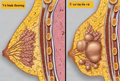 
U xơ tuyến vú là một dạng khối u ở vú lành tính xuất hiện khi có một số tế bào tăng sin
