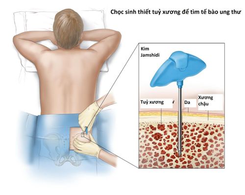 The role of bone marrow biopsies