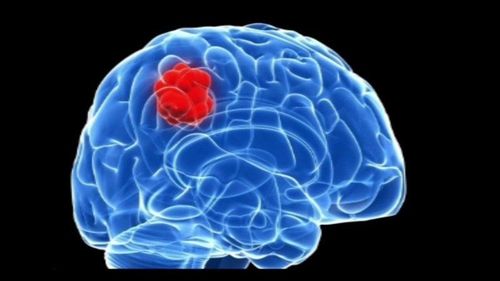 Signs and features of brain tumors