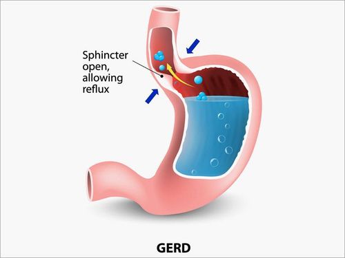 Phẫu thuật điều trị trào ngược dạ dày thực quản: Những điều cần biết