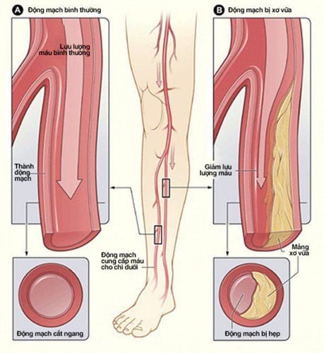 
Hình ảnh xơ vữa động mạch, hẹp động mạnh chi dưới
