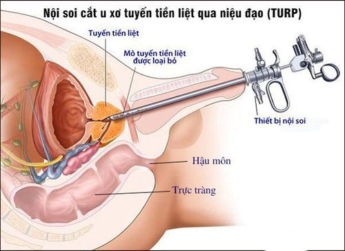 
Phương pháp nội soi cắt u phì đại lành tính tiền liệt tuyến qua đường niệu đạo
