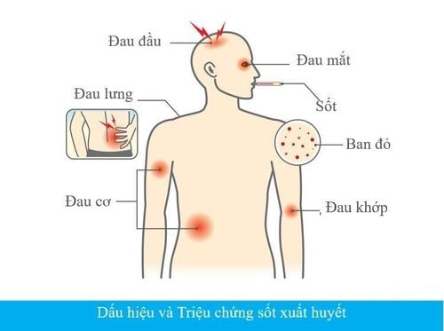 
Sốt, đau đầu, đau mắt, nổi ban đỏ là một trong những triệu chứng của bệnh sốt xuất huyết
