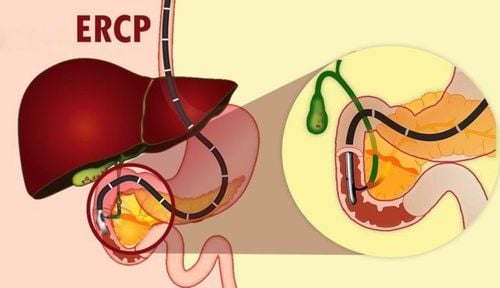 Viêm tụy cấp sau ERCP cắt cơ vòng điều trị rối loạn cơ vòng Oddi