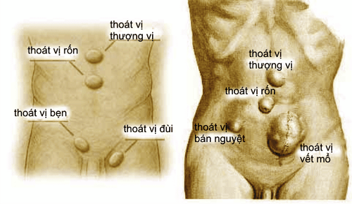 
Thoát vị thành bụng xảy ra khi thành cơ thành bụng bị hở hoặc bị yếu tạo một khối phồng trên bụng
