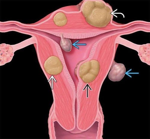 
U xơ tử cung có thể gây ra các biến chứng nguy hiểm như vô sinh
