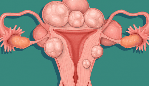 Uterine fibroids: How is it treated?