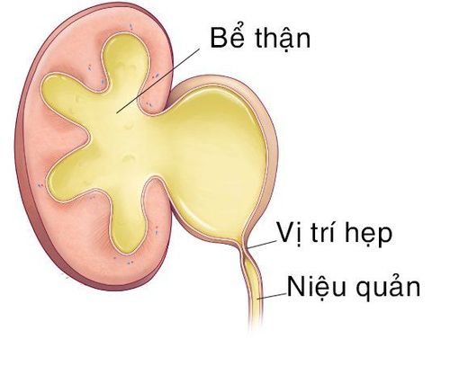 
Hẹp khúc nối bể thận - niệu quản là một bất thường ở phần nối giữa bể thận và niệu quản
