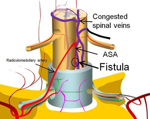 Diagnosis and treatment of spinal vascular malformations