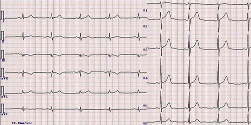 
Điện tâm đồ như một tiêu chuẩn chẩn đoán chính cho các bệnh lý tim mạch
