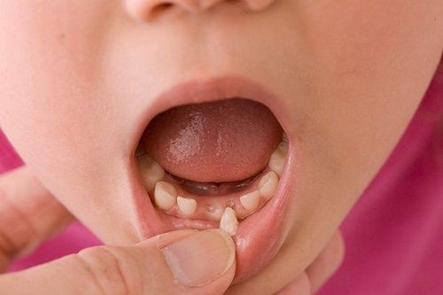 Bé bị gãy răng sữa có mọc lại bình thường được không?