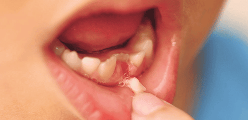 Children changing milk teeth: Should children be pulled out by themselves?