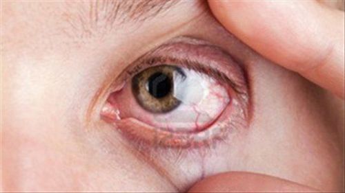 Causes and symptoms of glaucoma