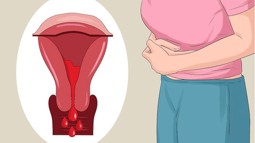 Lạc nội mạc tử cung thành bụng có điều trị tận gốc được không?