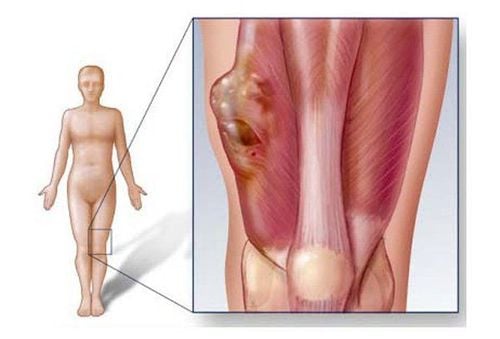 
Dấu hiệu phổ biến nhất của sarcoma mô mềm đó là xuất hiện một khối u hoặc sưng không gây đau
