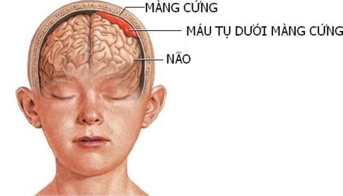 Endoscopic surgery to remove hematoma in the brain