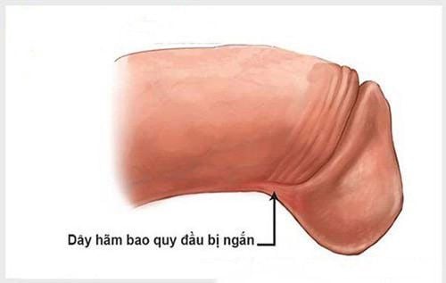 Torn Frenulum of the Foreskin: What You Need to Know