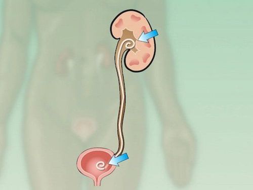 Treatment of urethral stricture, recurrent ureteral stenosis with stents