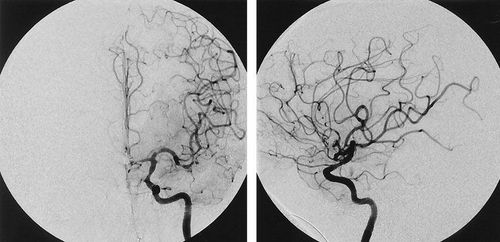 Angioplasty and stenting of the carotid artery digitally erase the background