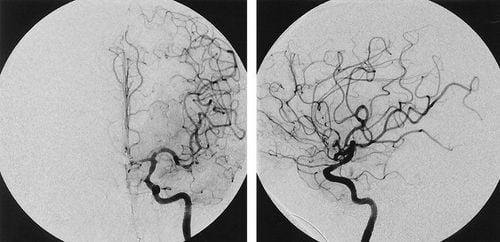 Digital background removal and placement of inferior vena cava filter