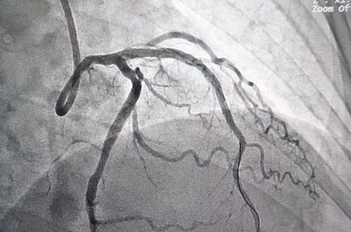 Application of background digitized angiography (DSA) in cardiology