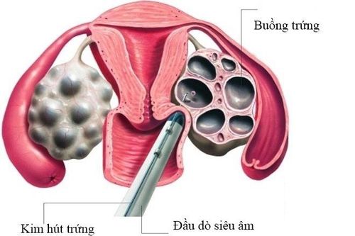 
Chọc hút trứng
