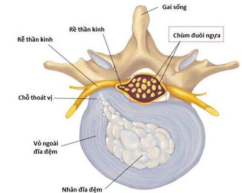 
Hội chứng chùm đuôi ngựa (CES) là tình trạng các rễ của đám rối thần kinh đuôi ngựa bị chèn ép
