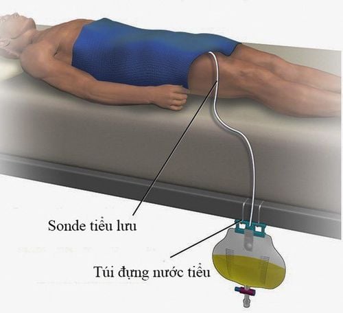 
Đặt sonde điều trị bí tiểu sau phẫu thuật để dẫn nước tiểu ra ngoài
