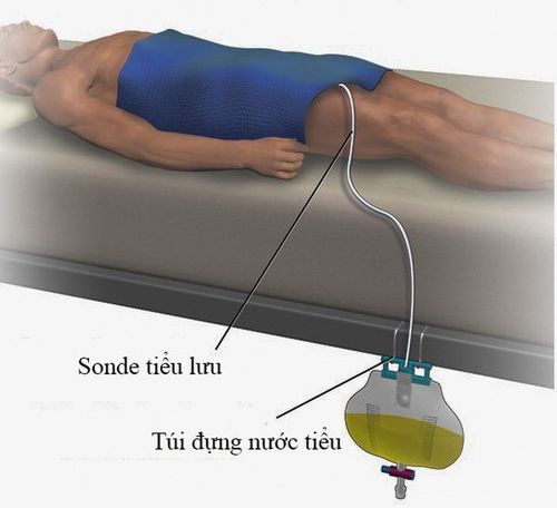 
Đặt sonde tiểu lưu, giúp tránh tình trạng trào ngược nước tiểu từ bàng quang lên thận
