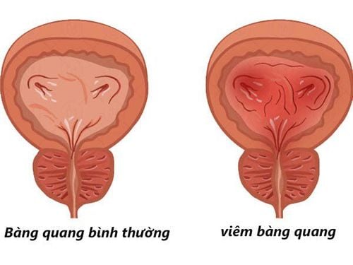 
Viêm bàng quang
