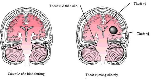 
Thoát vị màng não tủy nếu không được điều trị sớm sẽ gây ảnh lớn đến tâm lý người bệnh
